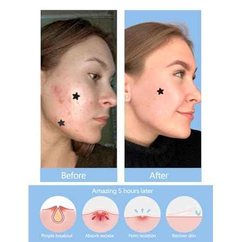 306 Counts Black Star Pimple Patches for Face, Hydrocolloid Star Acne Patches Refill, Cute Zit Covers for Face, Spot Stickers with Tea Tree, Salicylic Acid and Cica Oil