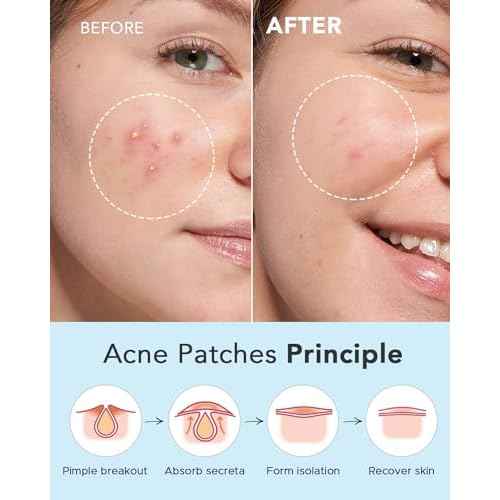 LitBear Acne Pimple Patches- Day and Night 6 Sizes 204 Dots Thin & Thick Hydrocolloid Patches with Witch Hazel, Tea Tree & Calendula Oil, Extra Adhesion for Face Zit Patch Dots