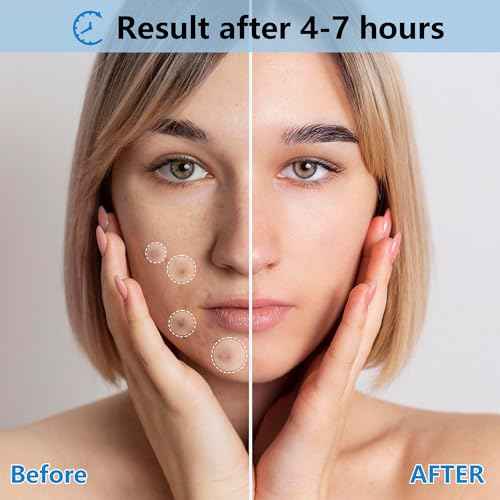 Invisible Pimple Patches for Face,Day and Night 4 Sizes 360 Counts Thin & Thick Hydrocolloid Acne Patches for Face and Skin, Zits Absorbing Patch, Covering Zits and Blemishes, Spot Stickers