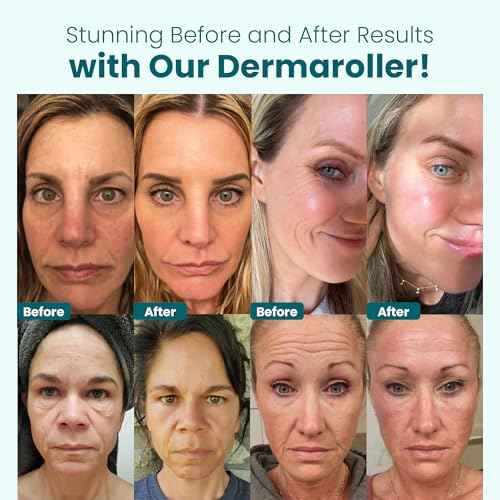 Gin Amber Beauty Derma Roller with Replaceable Head Design ? 192 Real individual needles, Micro Needling Roller for Face, Beard, and Scalp Care, 0.25mm Face Roller