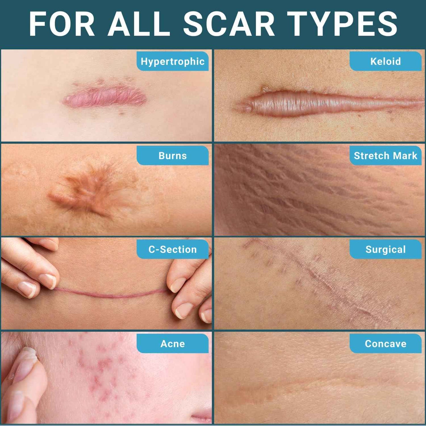 Silicone Scar Sheets, Silicone Scar Tape For Surgical Scars - Clinically Validated Technology Scar Removal Strips For Surgical, C-Section, Tummy Tuck, Keloid Scars - Reusable, Waterproof - Pack of 3