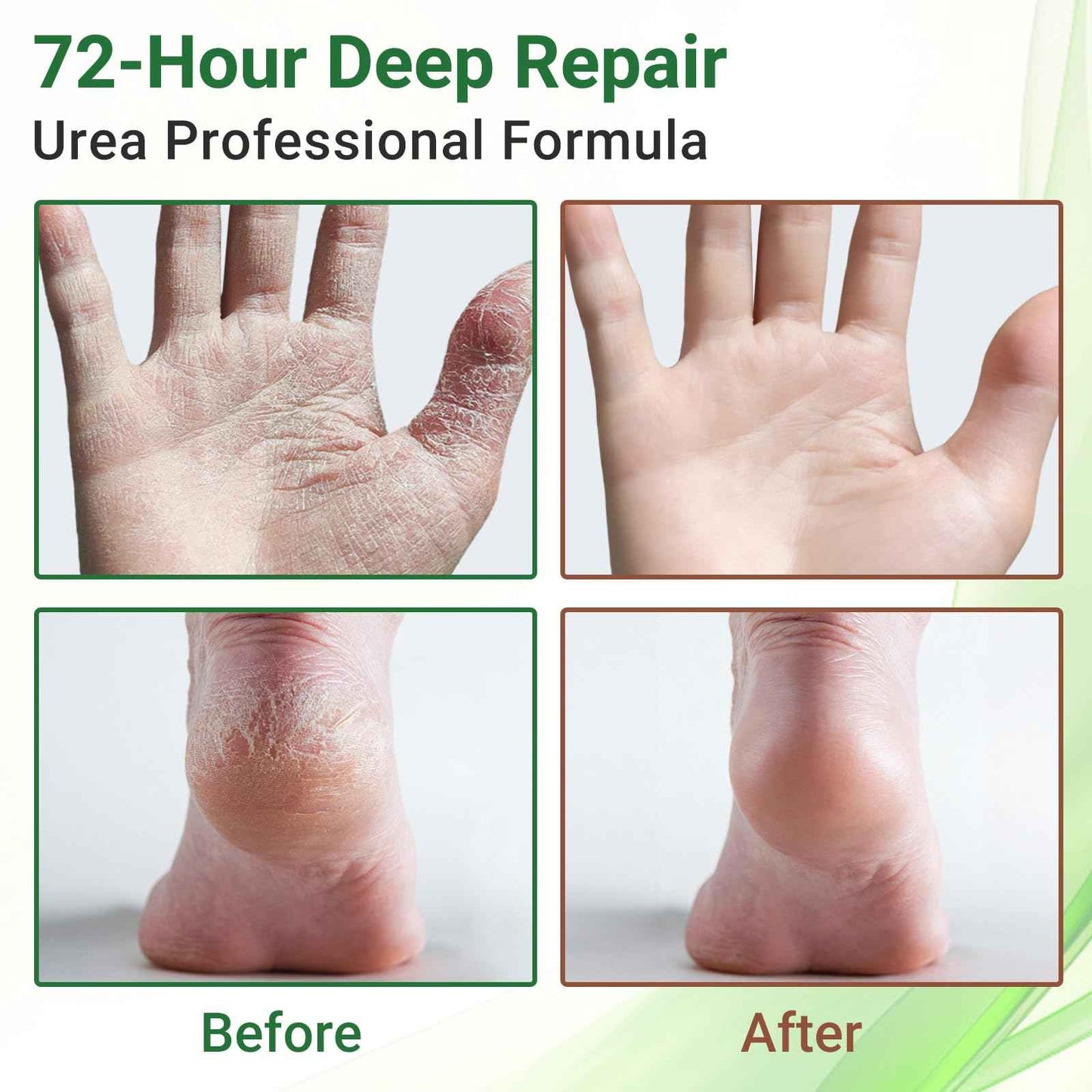 ishancare Moisturizing & Repair Cream with Urea – Intensive Treatment for Extremely Dry, Cracked Skin – Soothes Rough Hands & Heels – 200g Jar