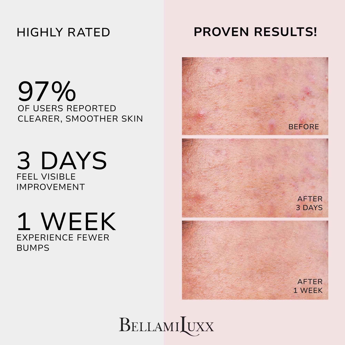 BellamiLuxx Body Acne Care Set: Butt Acne Treatment Lotion + Back & Body Acne Spray with 2% Salicylic Acid & Tea Tree Oil – Clears Breakouts, Soothes Redness & Prevents Bacne for Men, Women & Teens