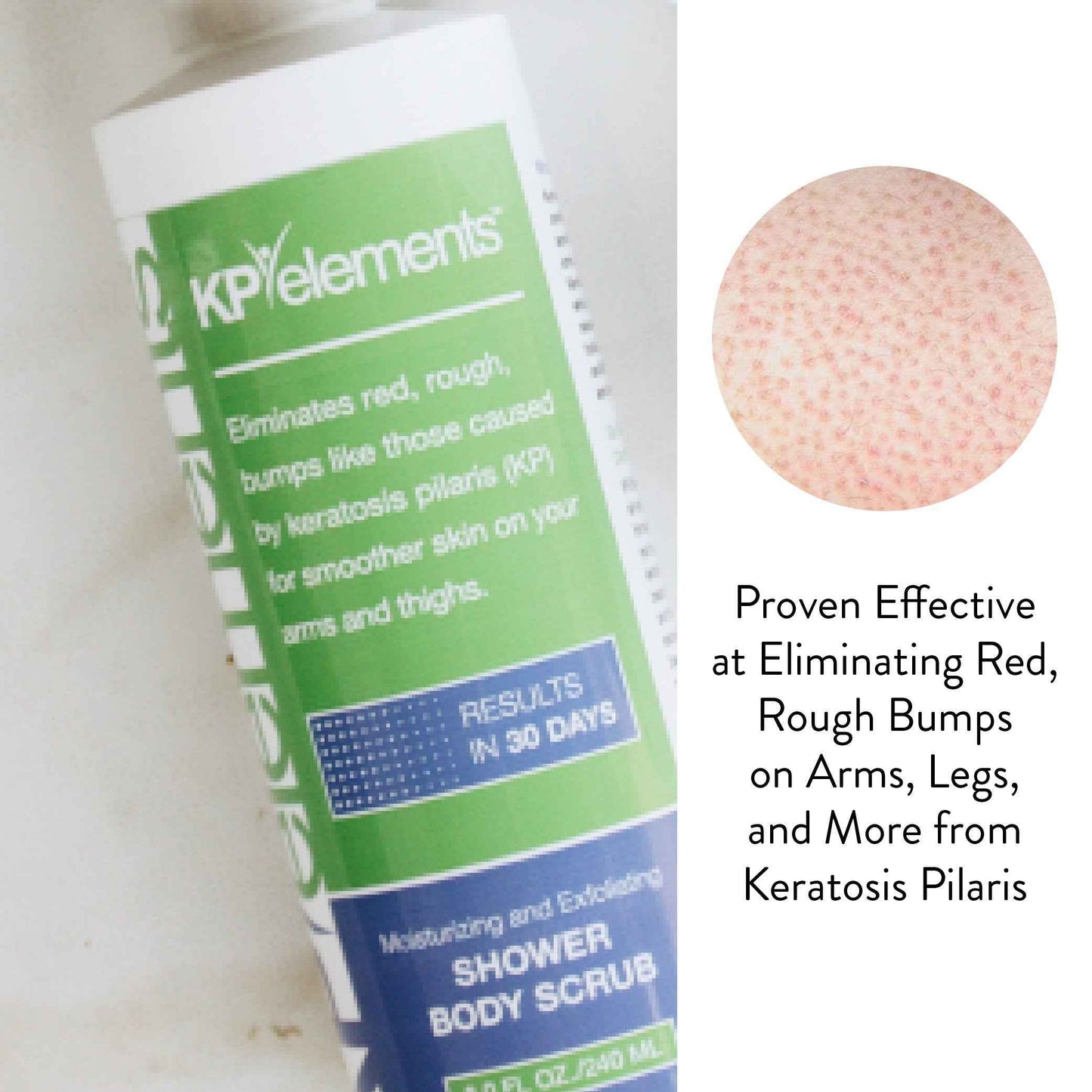 KP Elements Body Scrub (8 fl oz) | Keratosis Pilaris Treatment | Exfoliating Body Scrub and Body Moisturizer for Dry Skin | Helps Reduce Red Bumps | Body Skin Care Product for Men and Women