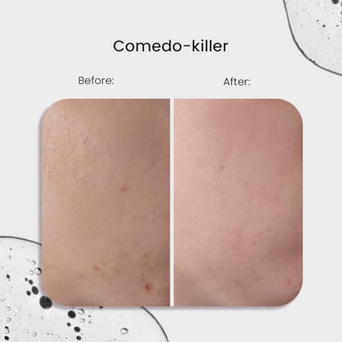 Comedo-killer 2% Salicylic Acid Serum - Blemish & Acne Spot Treatment - Exfoliating Serum with Azeloglycine & Gluconolactone - Clogged Pores & Closed Comedone Treatment - 30 ml/Net 1.01 Fl. Oz