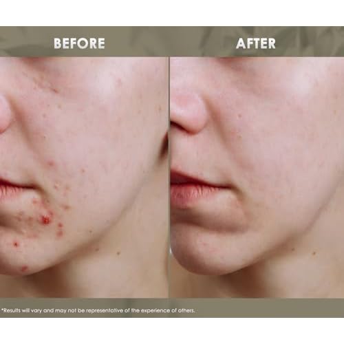 Redmint Acne Clear Facial Essential Oils | Made with 100% Organic TCM Herbal Ingredients Skincare |Natural Tried &True Acne Face Oil | Anti Acne Serum for Face to Skin Radiance| 20ml