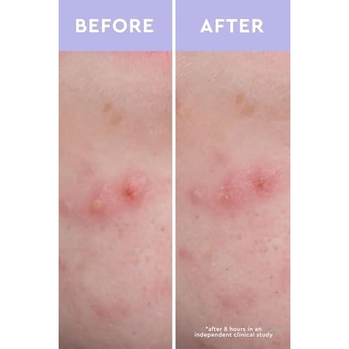 Acne Spot Patches by Florence by Mills Beauty