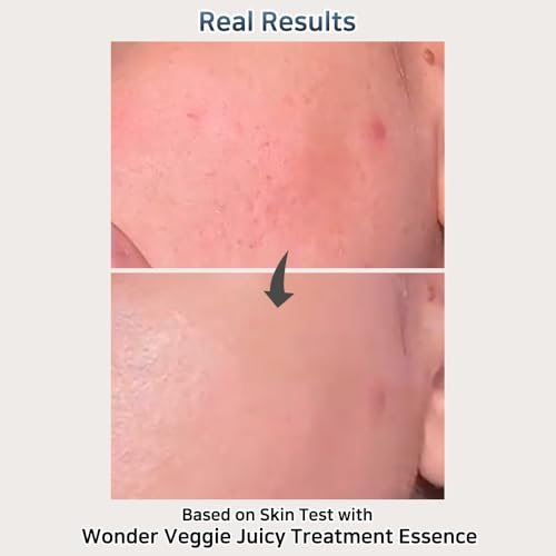 Hersteller Wonder Veggie Juicy Treatment Essence Toner ? Korean Hydrating Face Toner with Kale Extract ? Vegan, Non-Irritating, for Sensitive Skin ? 5.07 fl oz K-Beauty Skincare