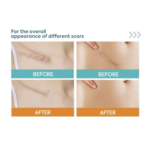 Silicone Scar Sheets 1.6" x 120" - Medical Grade, Long-Lasting, Reusable Tape Roll for C-Section, Surgical Scars, Keloid, Acne, Tummy Tuck Recovery & Wrinkle Treatment