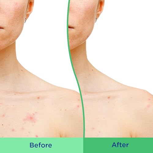 Differin Acne Body Scrub, 2% Salicylic Acid, 8 oz