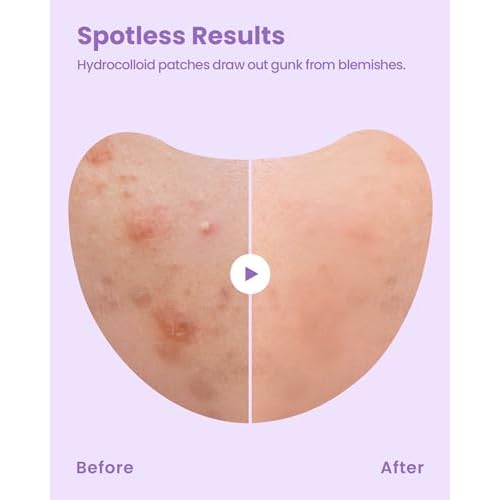 GLAM UP Spotless Patch - Hydrocolloid Spot Patch for Wide Acne area, Cheek, Body, Blackhead Cruelty Free and Vegan Friendly (12 Count)