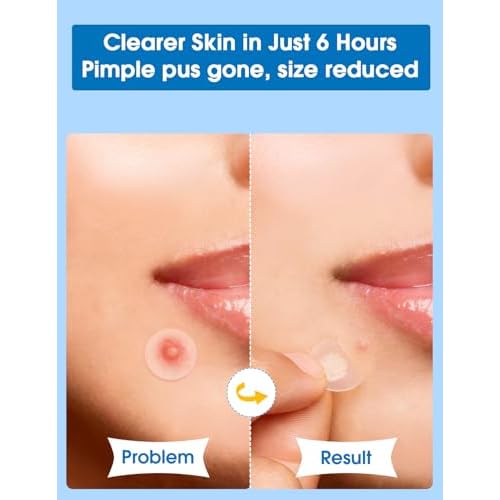 Pimple Patches for Face?Hydrocolloid Acne Patch, 6 Sizes (7/8/10/11/12/14 mm), 560 ct.?Tea Tree, Salicylic Acid & Centella-Invisible Waterproof Spot Dots, Absorb Fluid & Shrinking Zits and Whiteheads