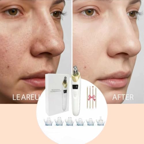 Echtur Electric Blackhead Remover with 5 Suction Heads