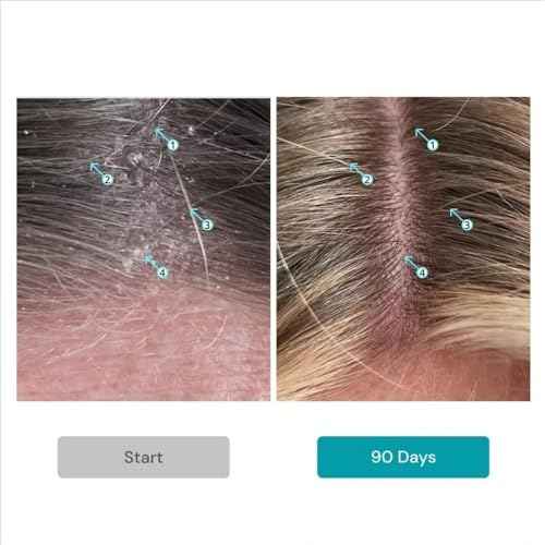 DS Labs Dandrene Dandruff Shampoo & Conditioner Kit, 205mL- for Itchy, Flaky Scalp, Exfoliating Shampoo, Moisturizing Conditioner, Supports Scalp Health & Oil Control