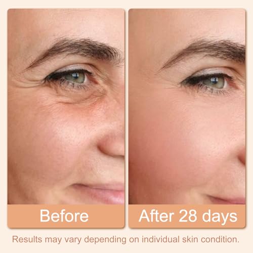 Hoakya Red Light Therapy Eye Massager for Dark Circles & Puffiness