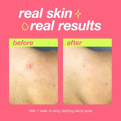 Dermalogica Clear Start Bacne Spray | Salicylic Acid Body Acne Treatment, 6oz