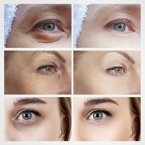 ALUSHEE 2-in-1 RF Microcurrent Eye Device for Puffiness & Wrinkles
