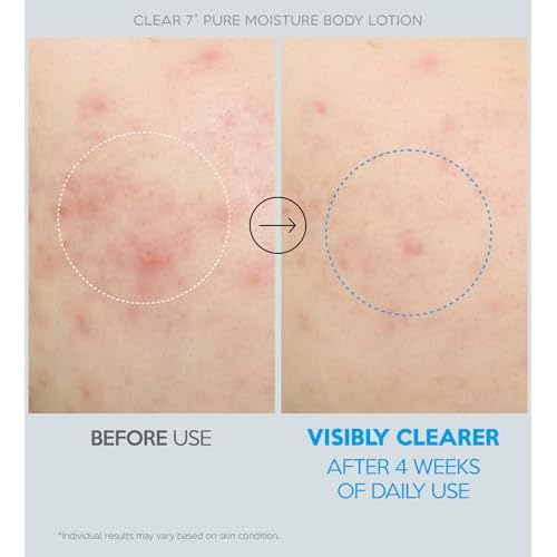 Troubless CLEAR 7 Plus Pure Moisture Body Lotion - Hydrating Body Moisturizer for Troubled Sensitive Skin w/ 7 Skincare Ingredients Gentle, Calming & Non Greasy Body Cream for Women & Men (16.9 fl oz)