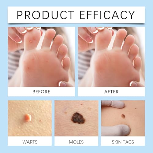 GIGAHEAL Wart & Mole Remover Serum for Face & Body - Fast Acting