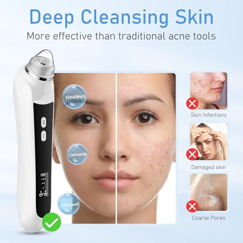 Ottleba HD Camera Blackhead Remover with 3 Suction Modes