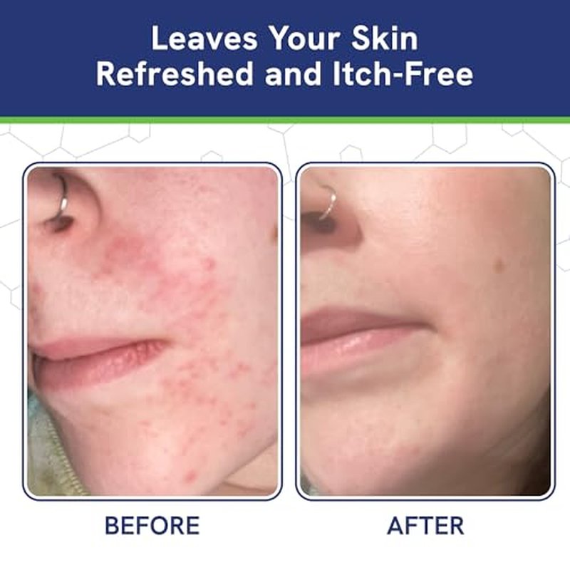 pHat 5.5 Moisturizing Cream for Seborrheic Dermatitis - 2oz