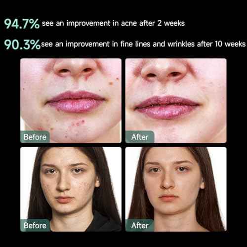 Aphrona¢ç | FDA cleared Moonlight LED Facial Mask Skin Care Mask, LED Light Therapy Red Blue light for Acne Removal Wrinkle Reduction