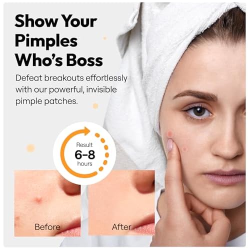 300 Pimple Patches ? Hydrocolloid Zit Stickers with Salicylic Acid, Tea Tree & Calendula | Helps Reduce Visible Blemishes ? Gentle, Overnight Skin Care