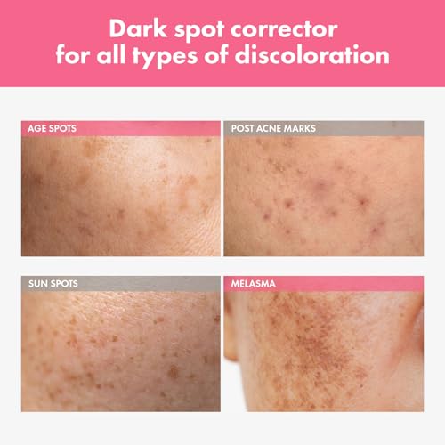 TOSOWOONG 7% Arbutin Spot Cream - Dark Spot & Blemish Treatment 20ml