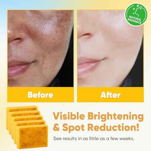 Treeroot 5 Pack Turmeric Soap for Dark Spots, 80g Kojic Acid and Turmeric Soap Bar, Face Even Skin Tone, Natural Potent Moisturizing Ingredient, Contains Vitamin C, Shea Butter, Lemon Oil, Retinol