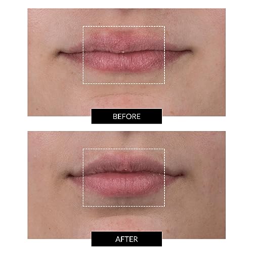 CurrentBody LED Lip Perfector - Anti-Aging Wearable Device
