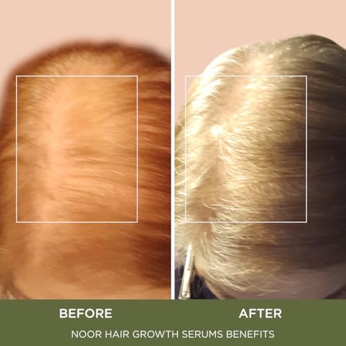 NOOR HAIR Growth Serum for Frizzy & Damaged Hair - Blocks Hair Loss