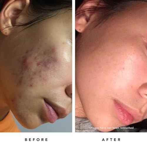 HERBIVORE Blue Tansy BHA & Enzyme Pore Refining Mask - Naturally Clarifies Acne, Blemishes & Redness, Vegan & Cruelty-Free, 60 mL / 2.02 oz