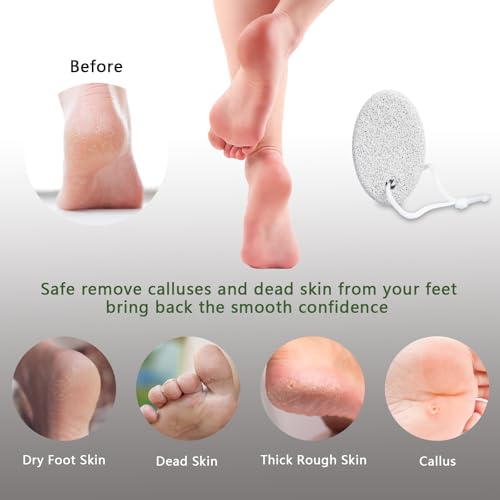Natural Foot Pumice Stone Set - Borogo 2-Pack White Callus Removers for Feet & Hands