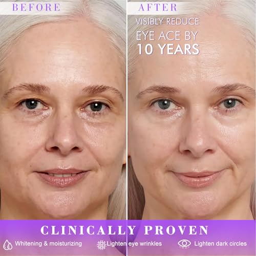 Eye Cream, Under Eye Cream Anti Aging for Dark Circles and Puffiness, 5% Niacinamide Cream for Wrinkles & Fine Line Reduction, -3¡Æ Ice Massage Head Treatment