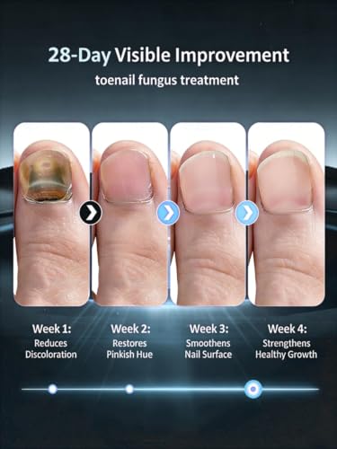Gembooxt Toenail Fungus Treatment Pen with Tea Tree Oil & Undecylenic Acid