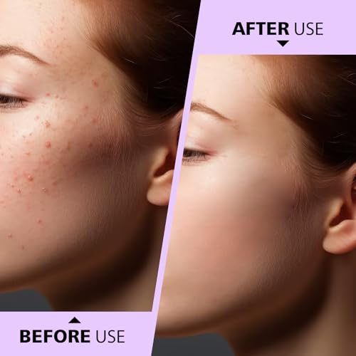 Silver Pimple Extractor Acne Removal Tool 2-in-1 Face Nose Blackhead Popper