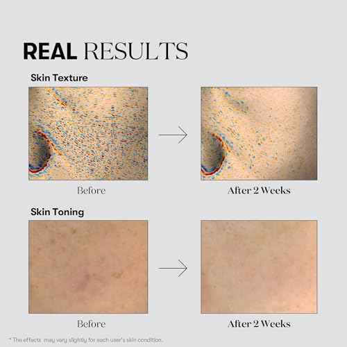 VT COSMETICS TX Toning Essence 1000 Shot, Tranexamic Acid Serum with Niacinamide, Glutathione for Radiant Glass Skin Face, Dark Spots, Sun Spots, Age Spots, Acne Scar, Korean Skin Care (1.01 fl. oz.)