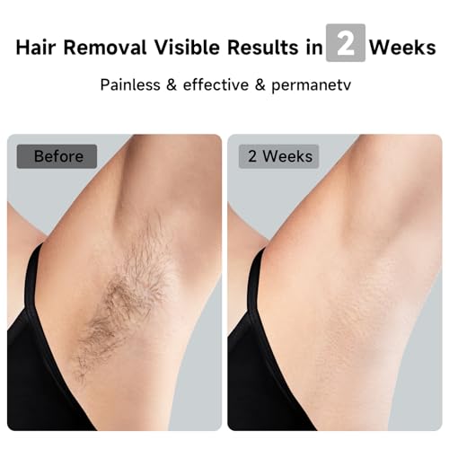 JOVS Laser Hair Removal Device White - Painless IPL Skin Rejuvenation & Body Care