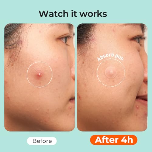 TKTK 443 Hydrocolloid Acne Patches, 5 Sizes Pimple Stickers