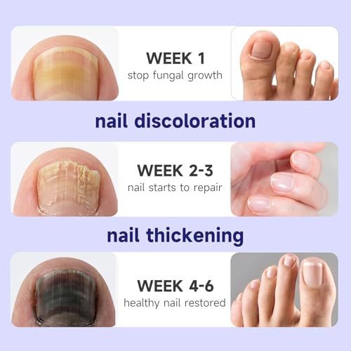 Nail Fungus Treatment Tolnaftate 30ml - Men & Women