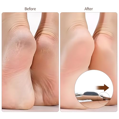 Stainless Steel Callus Shaver and Foot File Kit - Ergonomic Foot Care Tool
