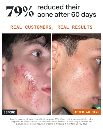 Norse Organics Fight Acne Kit - Complete 3-Step System with Arctic Botanicals