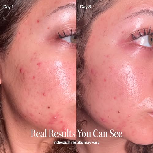 Solawave Bye Acne - FDA-Cleared Blue & Red Light Therapy Wand