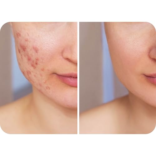 Hypochlorous Acid Spray for Face, Skin & Eyelids ? pH-Balanced HOCl Facial Spray Safe for Acne, Red & Sensitive Skin ? Gentle Non-Toxic Toner & Cleanser Mist for Clear, Hydrated Skin, 8 oz