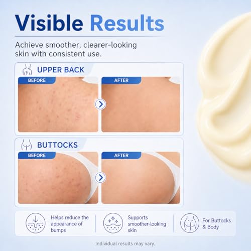 Body Acne Cream with 2% Salicylic Acid, Tea Tree Oil & Chamomile