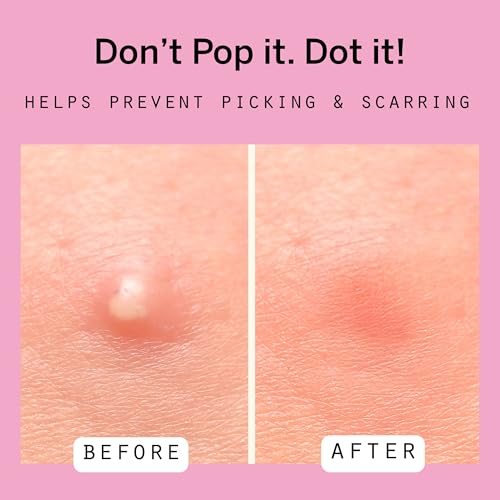 Dot Pimple & Zit Patches for Face ? All-Natural Custom Triple-Action Formula Absorbs, Clears & Brightens Acne Spots with Hydrocolloid, Vitamin C, Tea Tree Oil & Salicylic Acid (8 & 12 mm, 108 ct)
