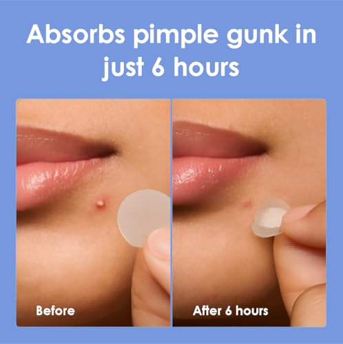 ZELIER Pimple Patches 2500 Count Hydrocolloid Roll Tape