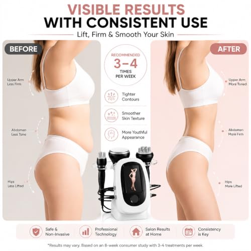 RF Skin Tightening Device 1MHz Anti-Wrinkle Face Lift