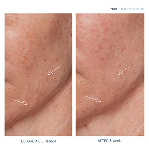 Santo Remedio, Piel Eterna, A.C.E. Retinol Intensive Rejuvenation Oil, Vitamin A, Vitamin C, Vitamin E, Squalane, Salicylic Acid, For Normal, Oily, or Combination Skin, 1 Fl. Oz.