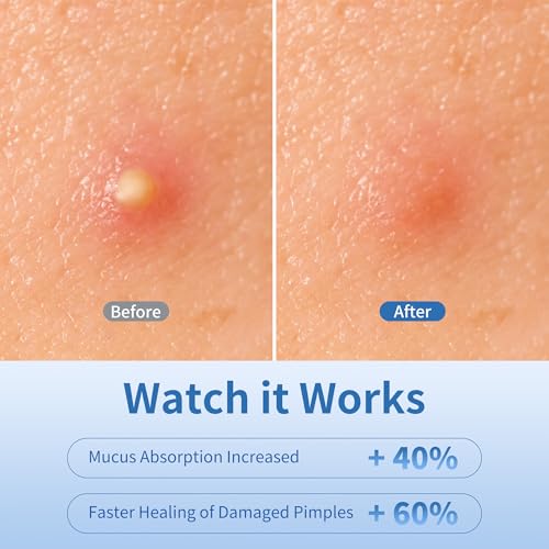 Pimple Patches for Face, 3 Size 280 Counts Hydrocolloid Acne Patches, Cute Star Pimple Stickers with Salicylic Acid, Tea Tree Oil & Calendula Oil, for Covering Zits and Blemishes
